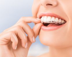 Woman wearing orthodontic silicone trainer. Invisible braces aligner. Mobile orthodontic appliance for dental correction.
