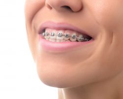Teeth with dental braces.  Orthodontic Treatment.  Dental care Concept.