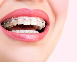 Close up open mouth with Ceramic and Metal Braces on beautiful Teeth. Broad Smile with Self-ligating Brackets. Orthodontic Treatment. Woman Smiling Showing Dental Braces.